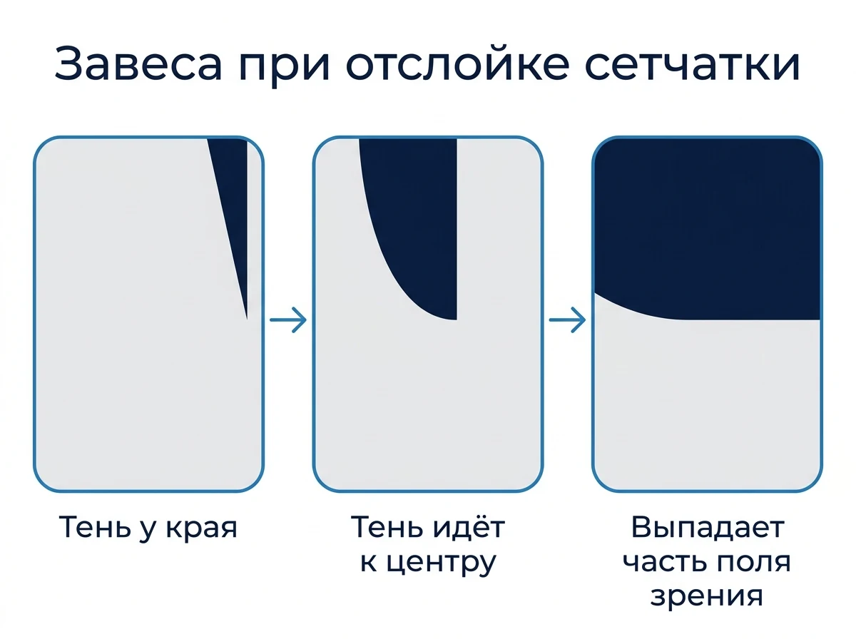 Как выглядит завеса при отслойке сетчатки Схема: тень при отслойке сетчатки надвигается с края поля зрения к центру