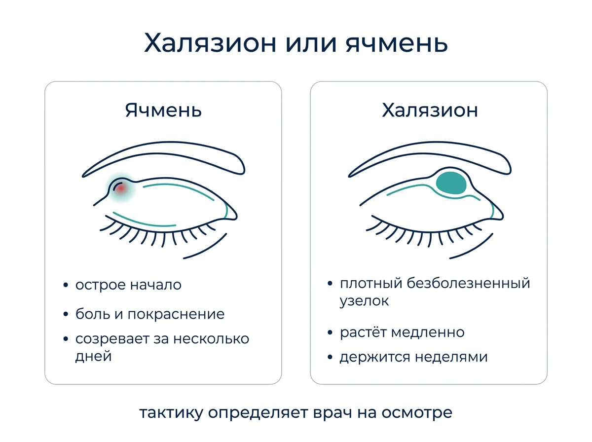 Чем халязион отличается от ячменя