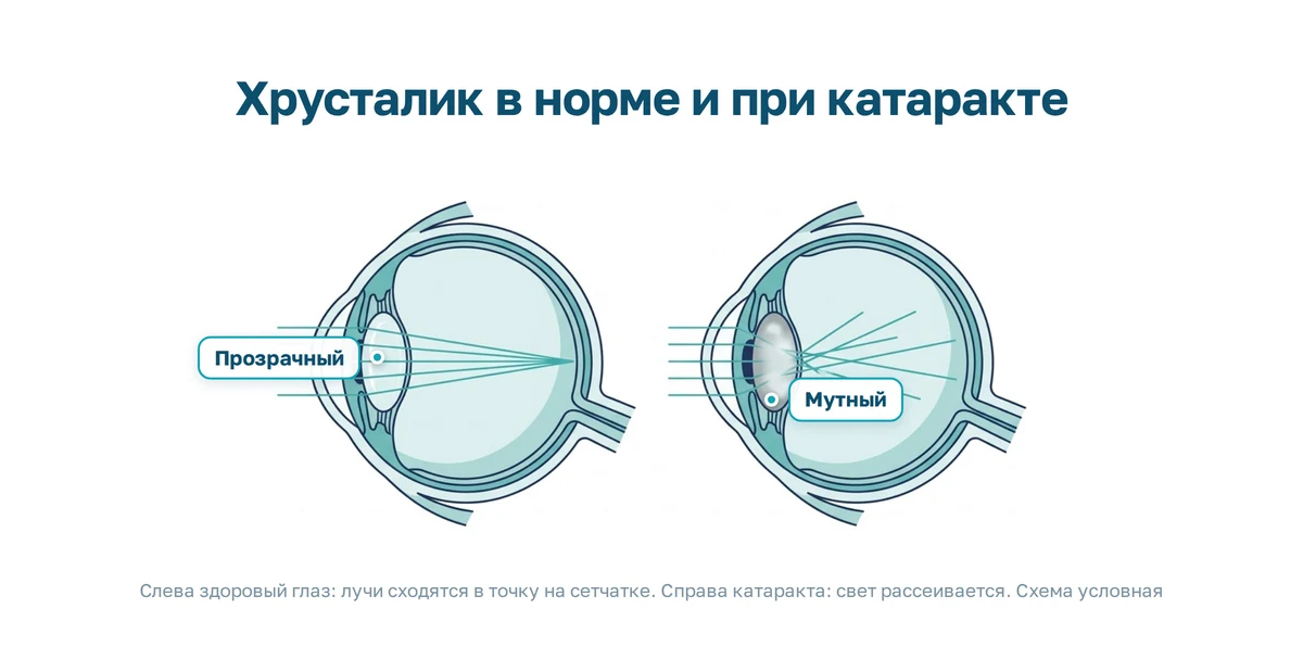 Схема: прозрачный и помутневший хрусталик глаза